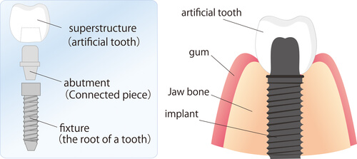 Зубные импланты в Германии