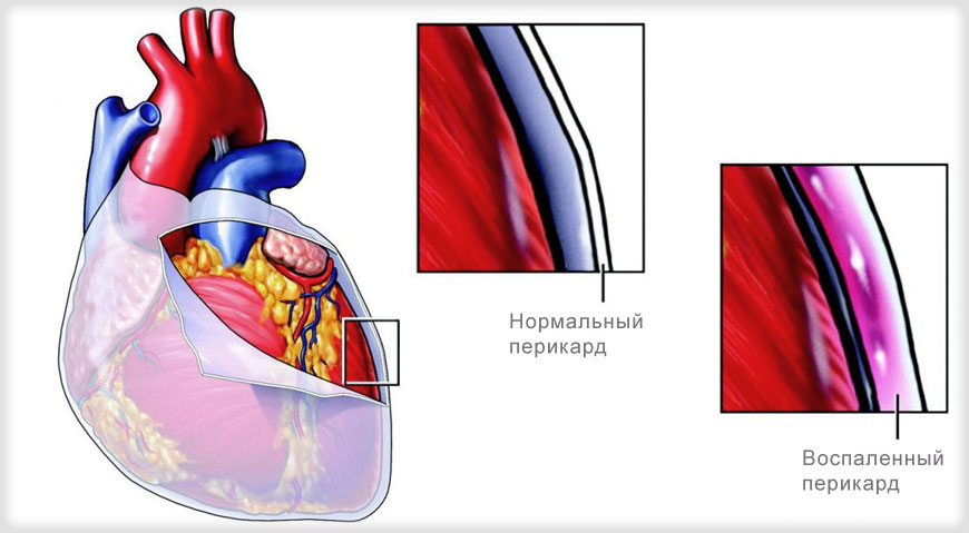 Лечение амилоидоза сердца в Турции