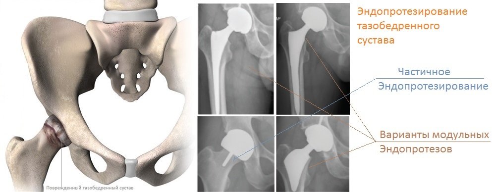 Эндопротезирование тазобедренного сустава в ведущих центрах и клиниках за рубежом