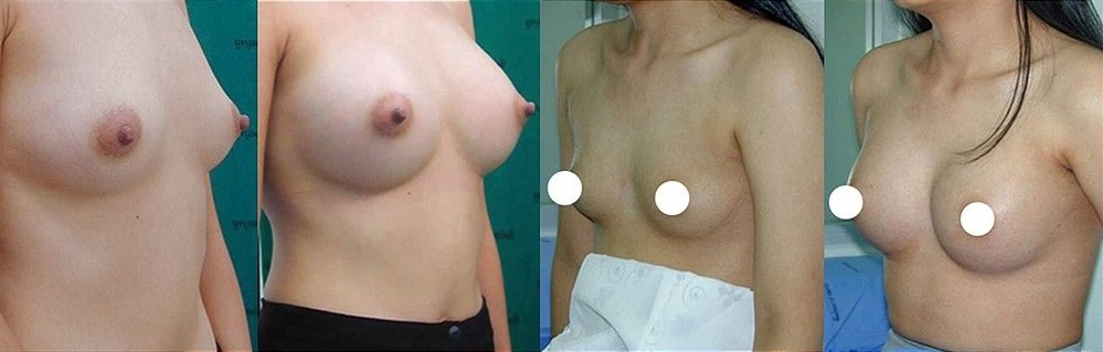 Увеличение груди в ведущих центрах и клиниках Тайланда